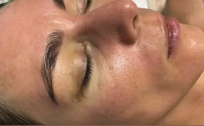 After a Green Peel treatment
