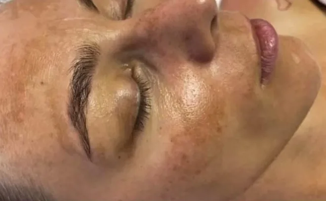 Before a Green Peel treatment